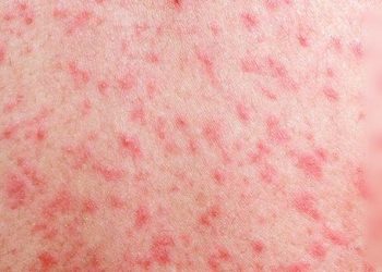 پنجاب میں خناق اور خسرے سے  متعدد بچےجاں بحق ہو گئے